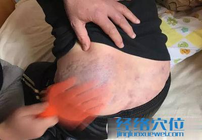 拍打八髎穴出痧圖參考