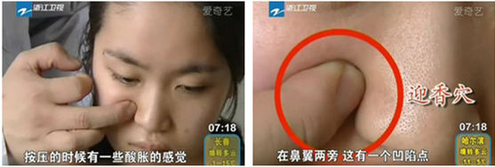 迎香穴的位置圖