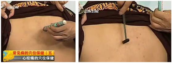 艾灸和皮膚針叩刺心俞穴的操作示范圖