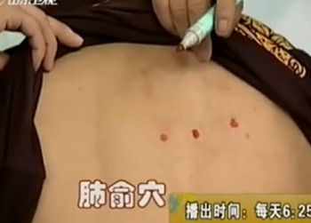 治療咳嗽的第二個(gè)穴位：肺俞穴位圖