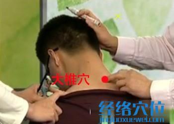 治療落枕的穴位：大椎穴位