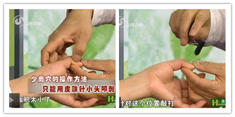 少商穴的操作方法只能用皮膚針小頭叩刺，因為它面積太小了，敲打出血來
