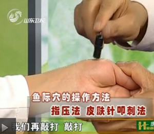  皮膚針叩刺法，敲打魚際穴，要求敲出血來。