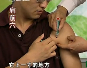 治療肩周炎的穴位：肩前穴的位置圖