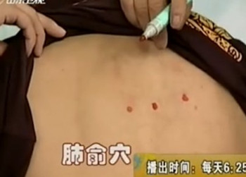 治療咳嗽的第二個(gè)穴位：肺俞穴位圖