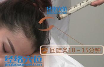 艾灸百會(huì)穴的示意圖