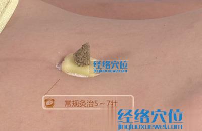 艾灸的方法：隔鹽灸的示范圖