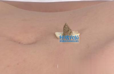 艾灸的方法：隔蒜灸的示范圖